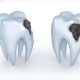 cavity teeth illustration