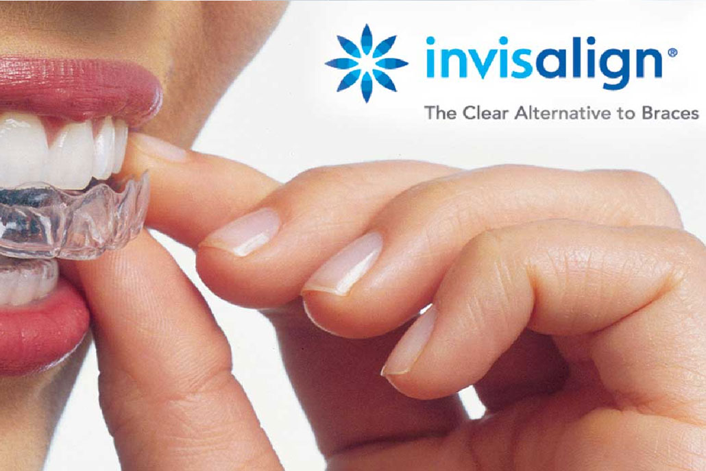 Frequently Asked Questions About Invisalign - My Dentist News.