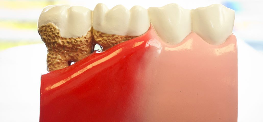 gum disease bc